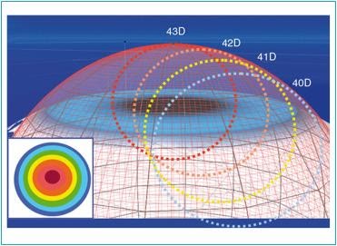 Corneal topography in clinical practice - ScienceDirect