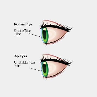 Dry Eye Treatment | Dry Eye Center At Professional Vision Care